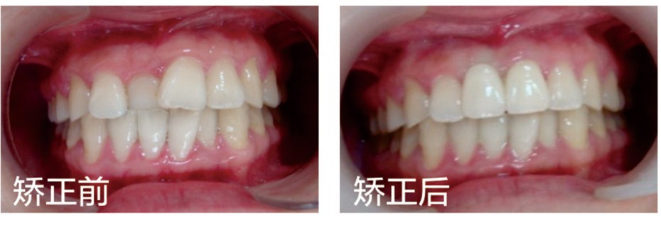 我做Ormco自鎖托槽不拔牙矯正掏了2萬多，這費用你覺得貴嗎