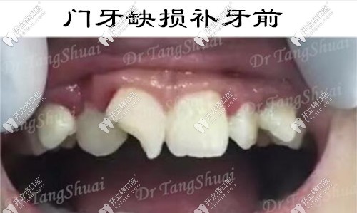 兒子門牙缺損一個(gè)角,用意大利美塑樹(shù)脂補(bǔ)的牙還挺耐磨