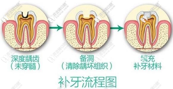 蛀牙別拖久喲!偷偷告訴你杭州做3M樹脂補(bǔ)牙的價(jià)格在這！