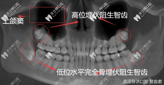 武漢拔牙案例|超聲骨刀微創(chuàng)拔除埋伏阻生智齒,詳解過(guò)程圖解